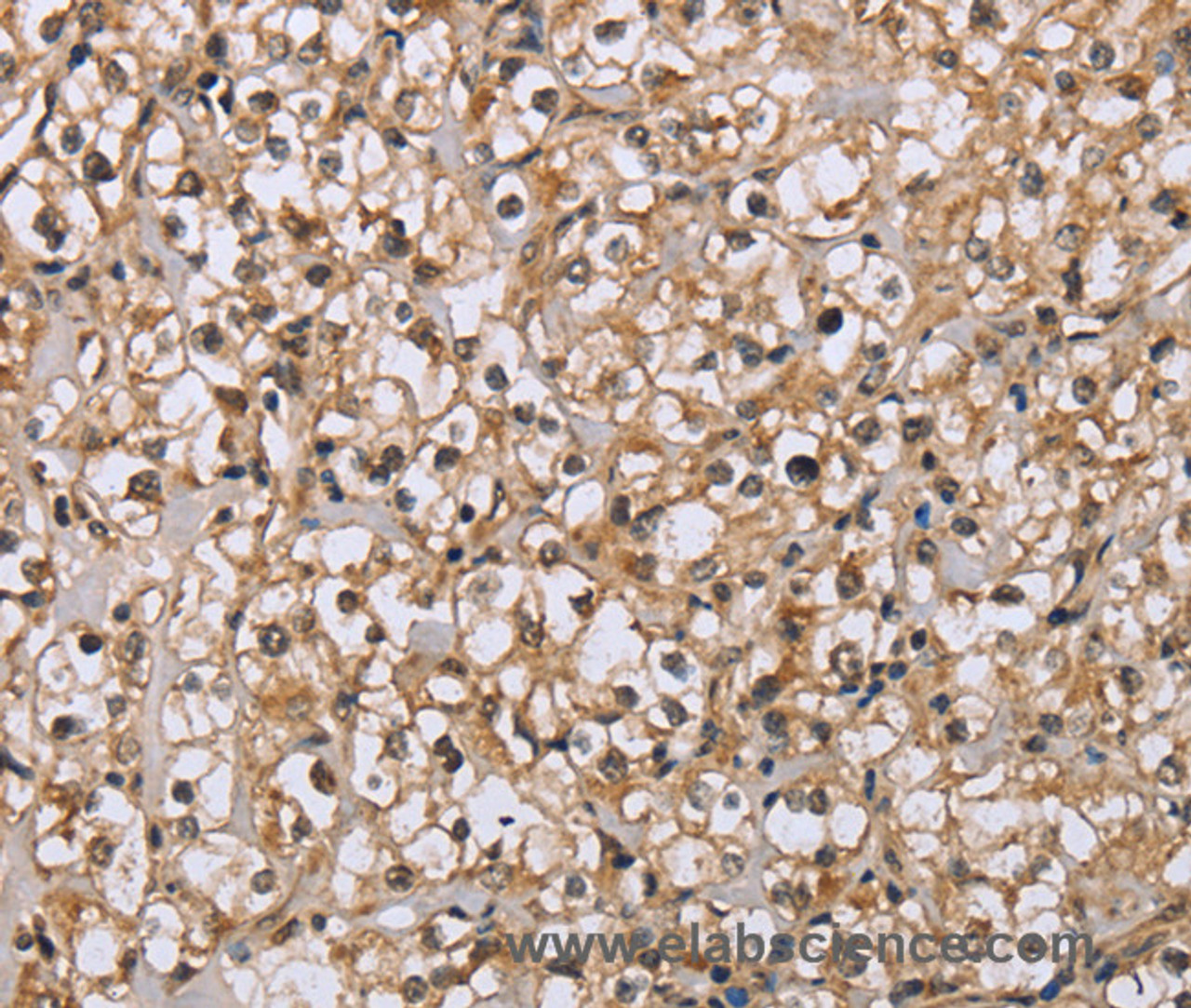 Immunohistochemistry of paraffin-embedded Human prostate cancer tissue using DLD Polyclonal Antibody at dilution 1:35