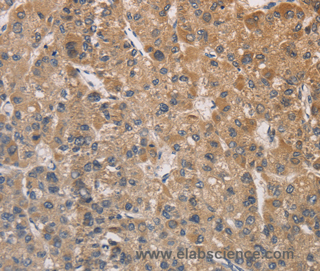 Immunohistochemistry of paraffin-embedded Human liver cancer tissue using DSTN Polyclonal Antibody at dilution 1:30