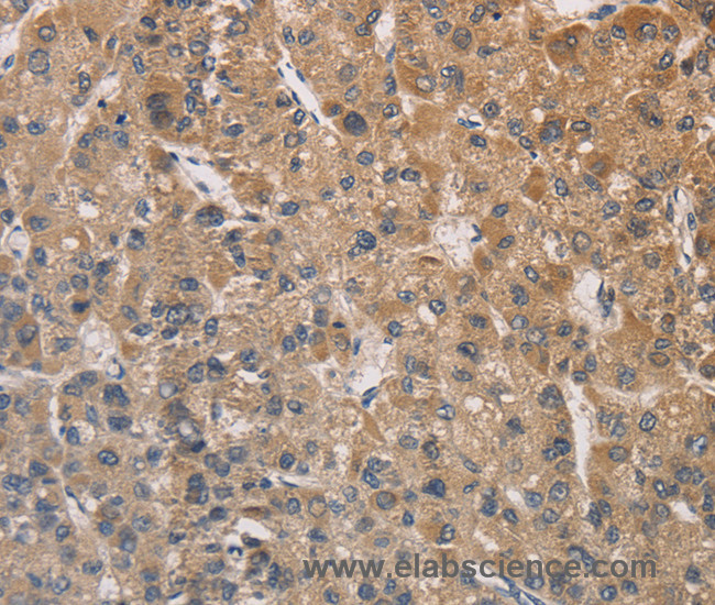 Immunohistochemistry of paraffin-embedded Human liver cancer tissue using DSTN Polyclonal Antibody at dilution 1:30