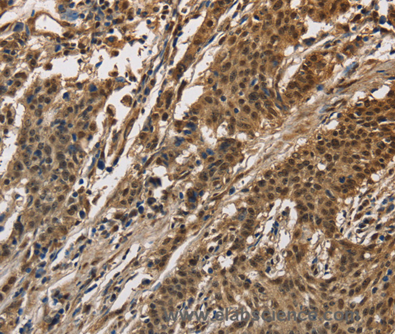 Immunohistochemistry of paraffin-embedded Human gasrtic cancer tissue using CCAR1 Polyclonal Antibody at dilution 1:40