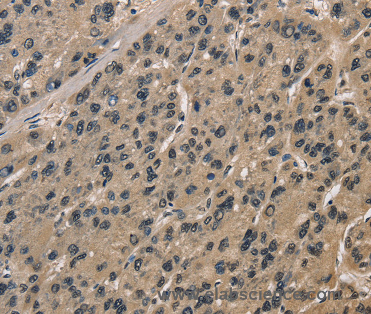 Immunohistochemistry of paraffin-embedded Human liver cancer tissue using CCAR1 Polyclonal Antibody at dilution 1:40