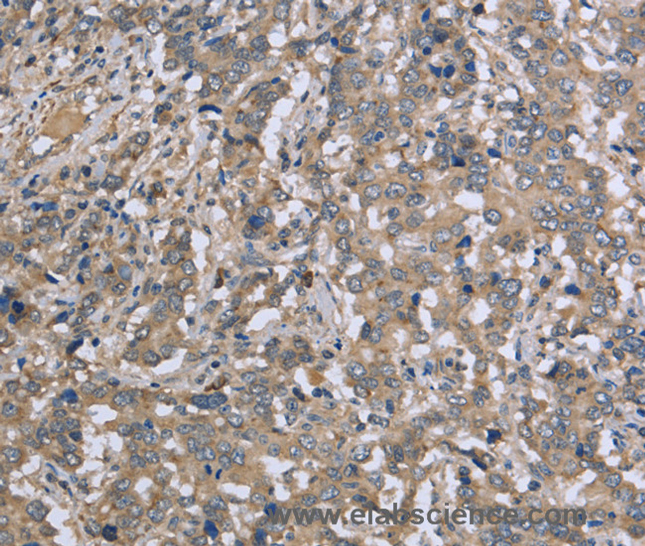 Immunohistochemistry of paraffin-embedded Human liver cancer tissue using DTNB Polyclonal Antibody at dilution 1:50