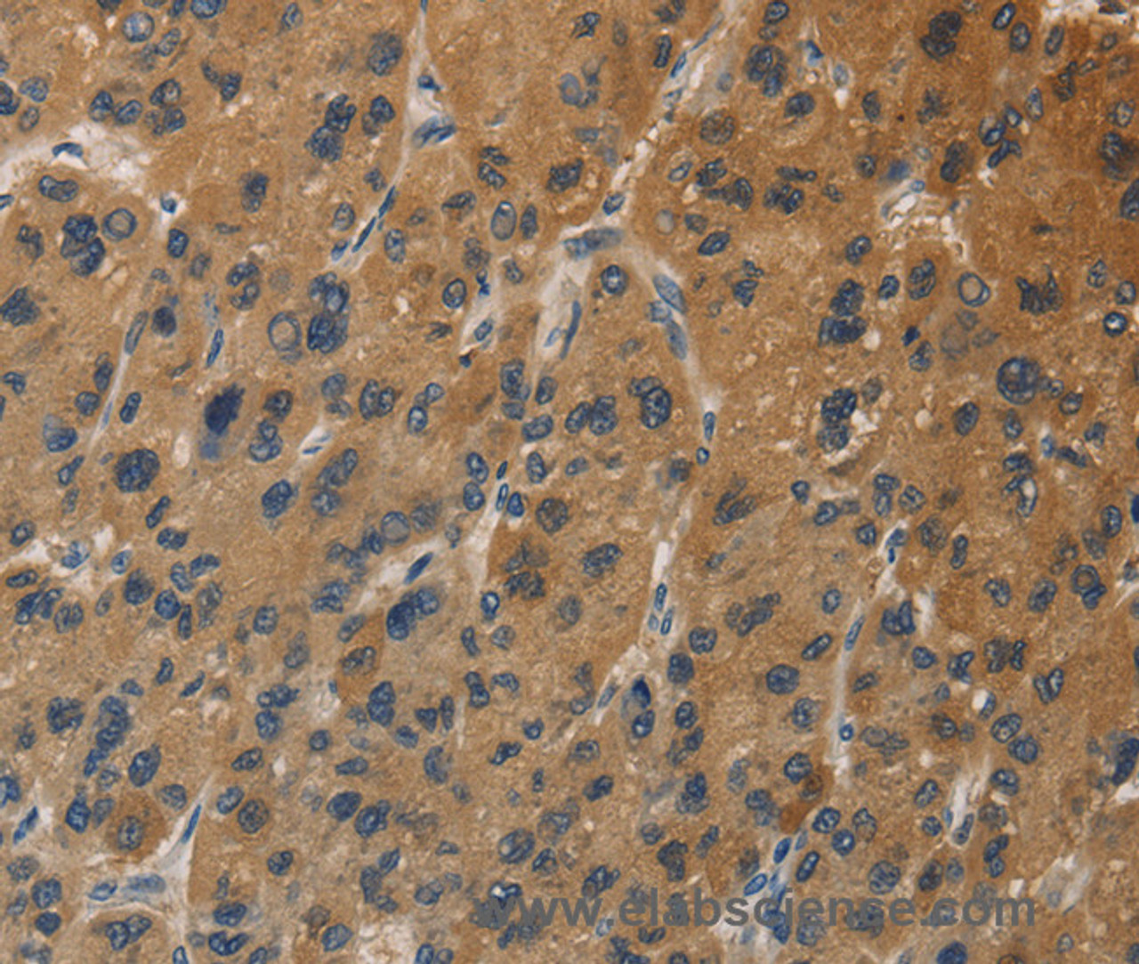Immunohistochemistry of paraffin-embedded Human liver cancer tissue using DUSP23 Polyclonal Antibody at dilution 1:30