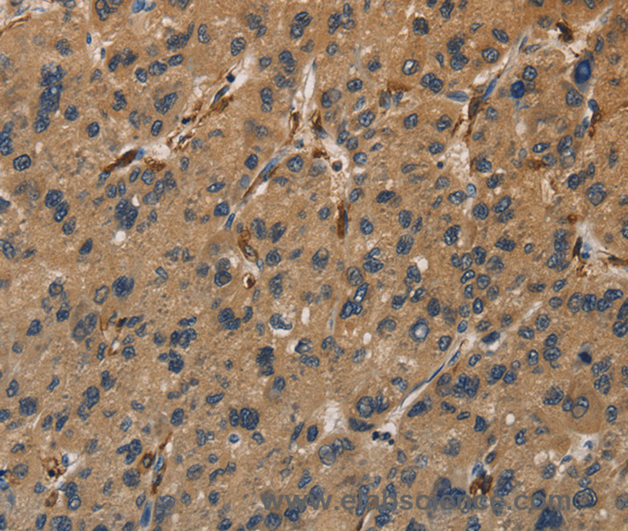 Immunohistochemistry of paraffin-embedded Human liver cancer tissue using UBE2S Polyclonal Antibody at dilution 1:40
