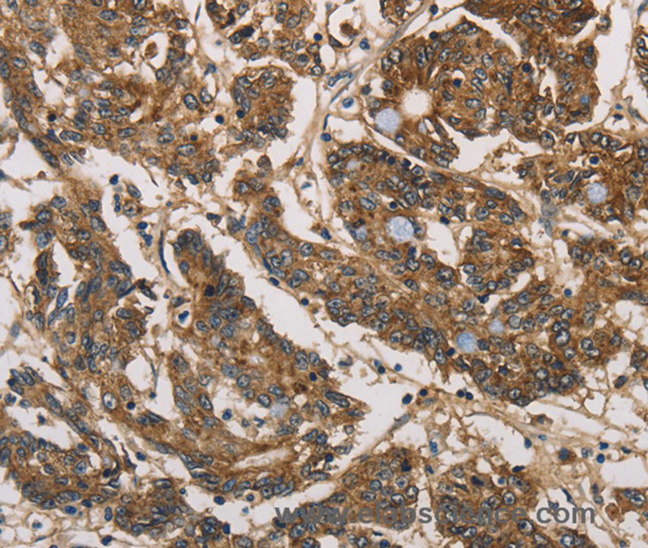 Immunohistochemistry of paraffin-embedded Human colon cancer tissue using UBE2S Polyclonal Antibody at dilution 1:40