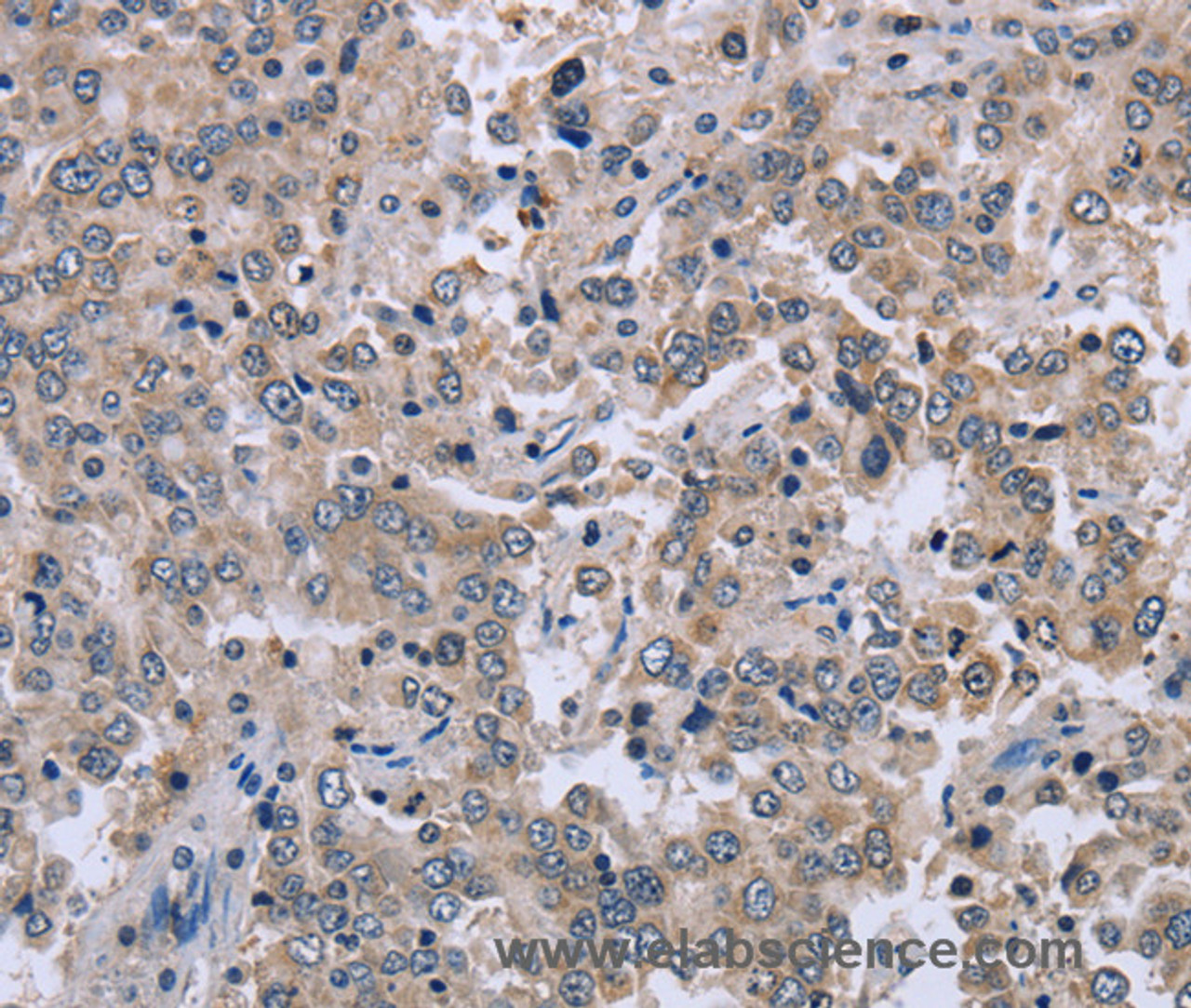 Immunohistochemistry of paraffin-embedded Human liver cancer tissue using EID1 Polyclonal Antibody at dilution 1:40