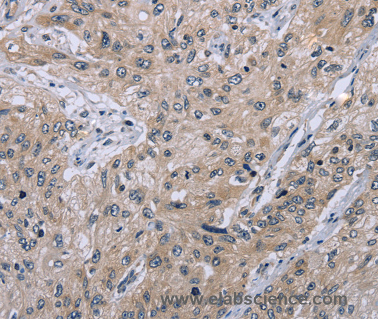 Immunohistochemistry of paraffin-embedded Human esophagus cancer tissue using EID1 Polyclonal Antibody at dilution 1:40