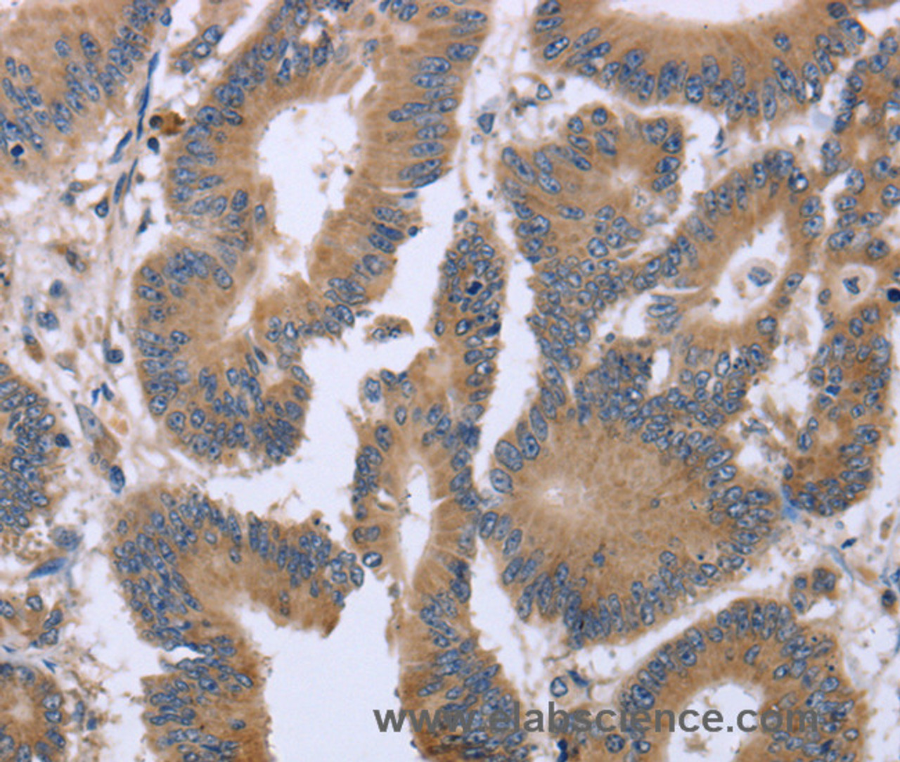 Immunohistochemistry of paraffin-embedded Human colon cancer tissue using KIAA1324 Polyclonal Antibody at dilution 1:30