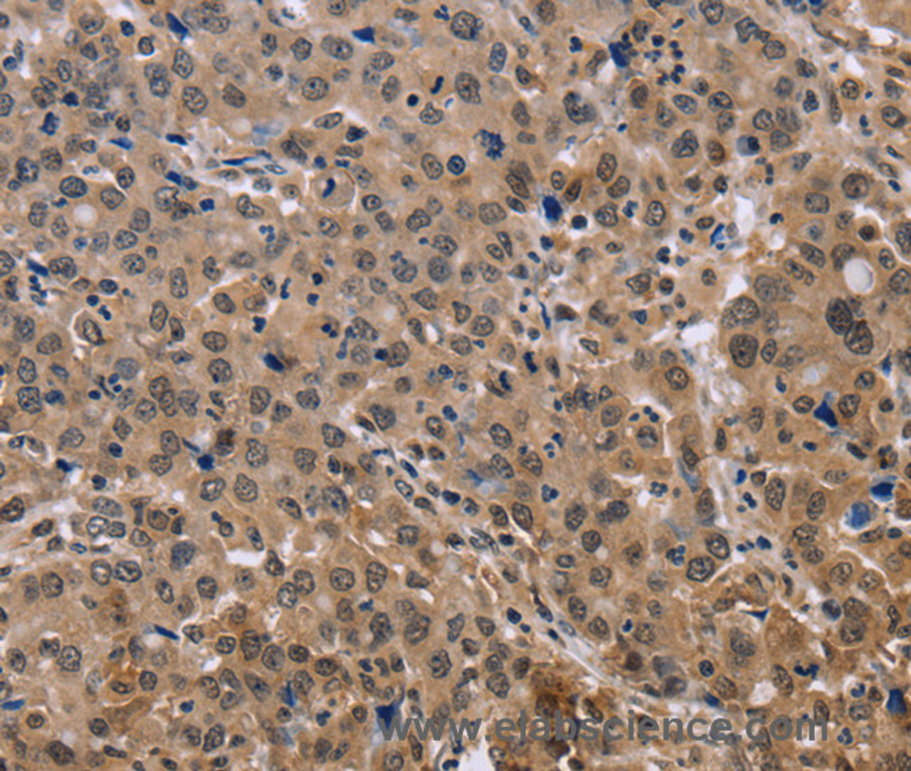 Immunohistochemistry of paraffin-embedded Human liver cancer tissue using KIF25 Polyclonal Antibody at dilution 1:40