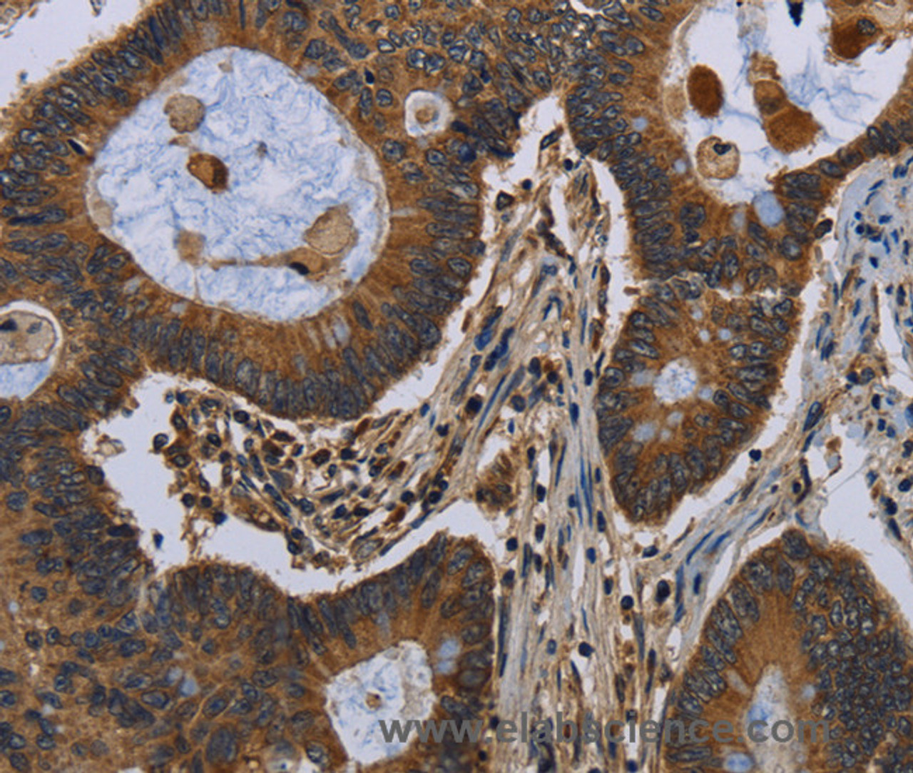 Immunohistochemistry of paraffin-embedded Human colon cancer tissue using FGF18 Polyclonal Antibody at dilution 1:40