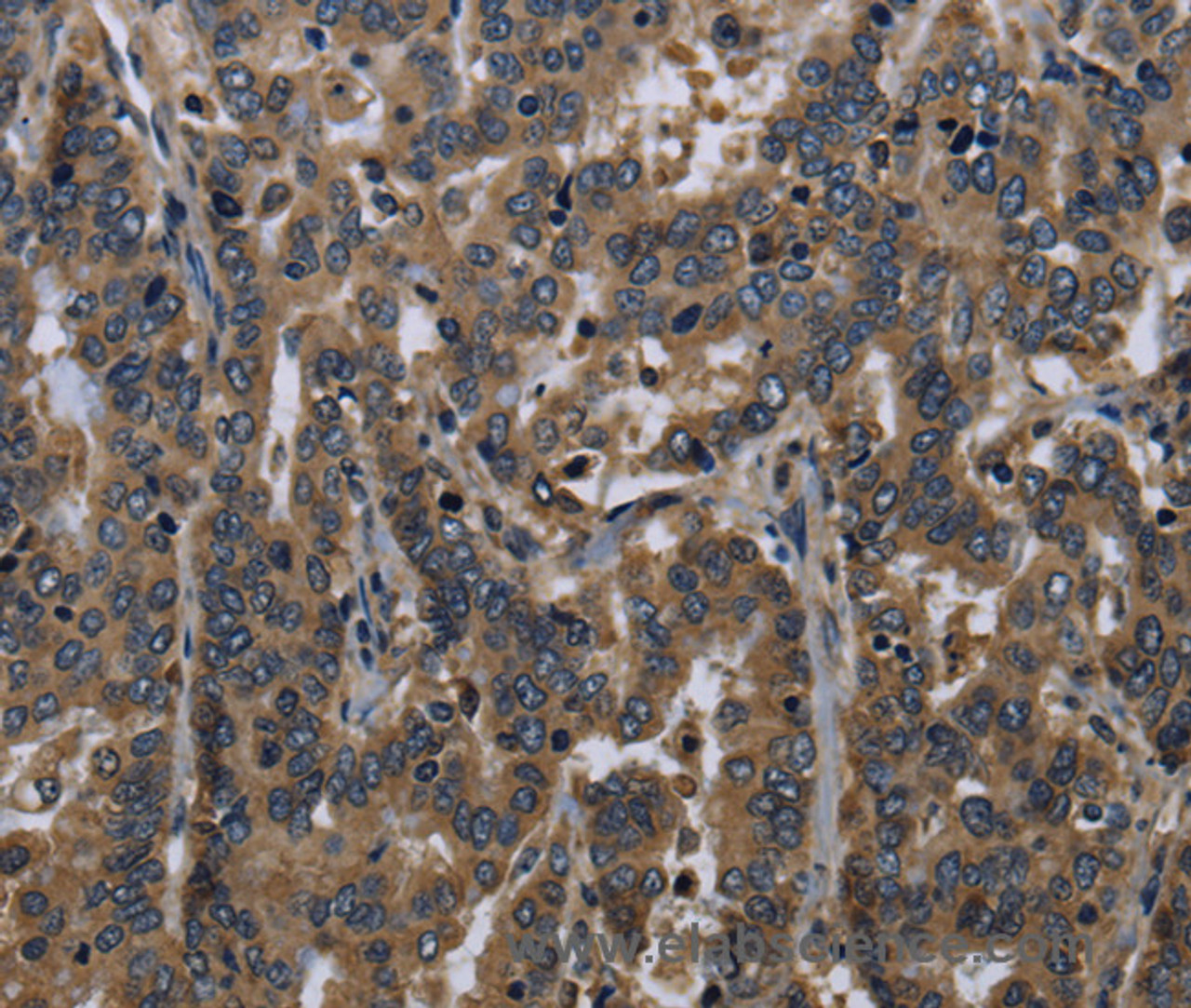Immunohistochemistry of paraffin-embedded Human liver cancer tissue using FGF18 Polyclonal Antibody at dilution 1:40