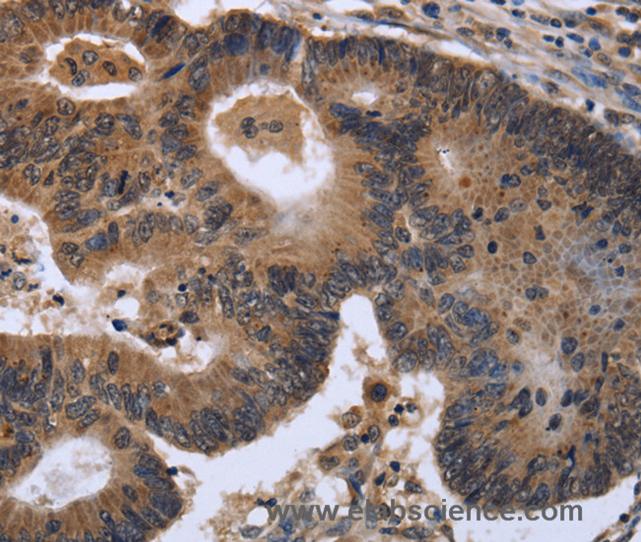 Immunohistochemistry of paraffin-embedded Human colon cancer tissue using FGF21 Polyclonal Antibody at dilution of 1:40