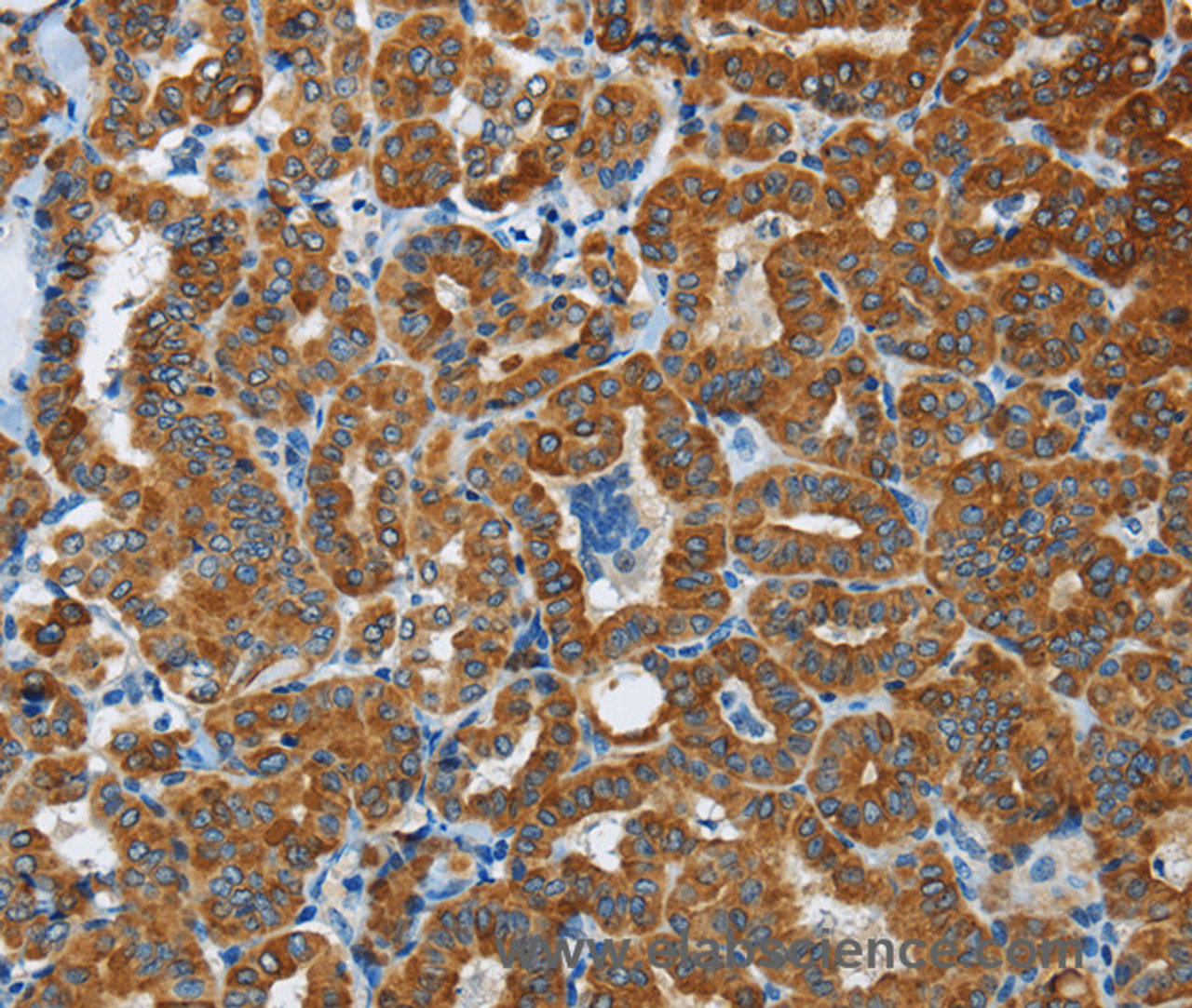 Immunohistochemistry of paraffin-embedded Human thyroid cancer tissue using FLCN Polyclonal Antibody at dilution 1:40