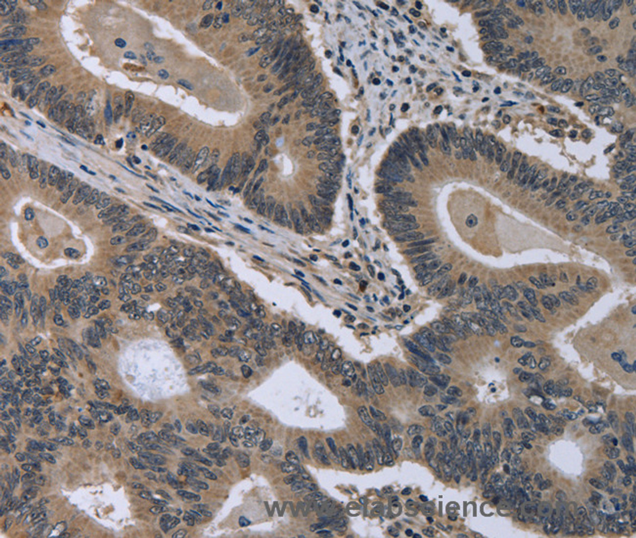 Immunohistochemistry of paraffin-embedded Human colon cancer using MCM3AP Polyclonal Antibody at dilution of 1:30