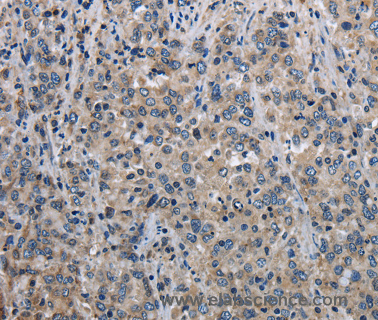 Immunohistochemistry of paraffin-embedded Human liver cancer using MCM3AP Polyclonal Antibody at dilution of 1:30