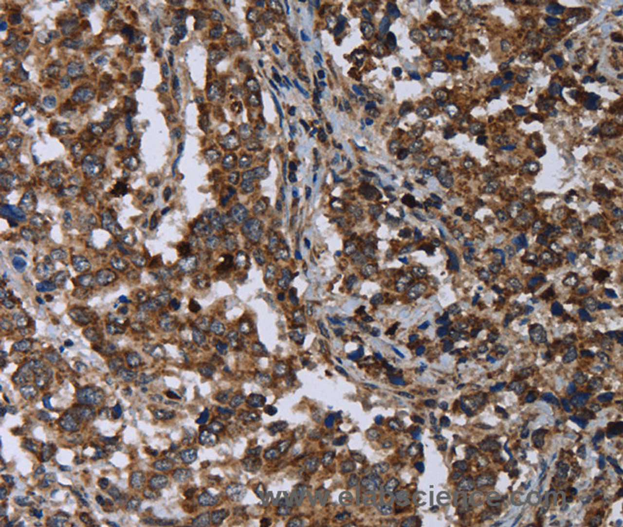 Immunohistochemistry of paraffin-embedded Human liver cancer tissue using DNAJC15 Polyclonal Antibody at dilution 1:40