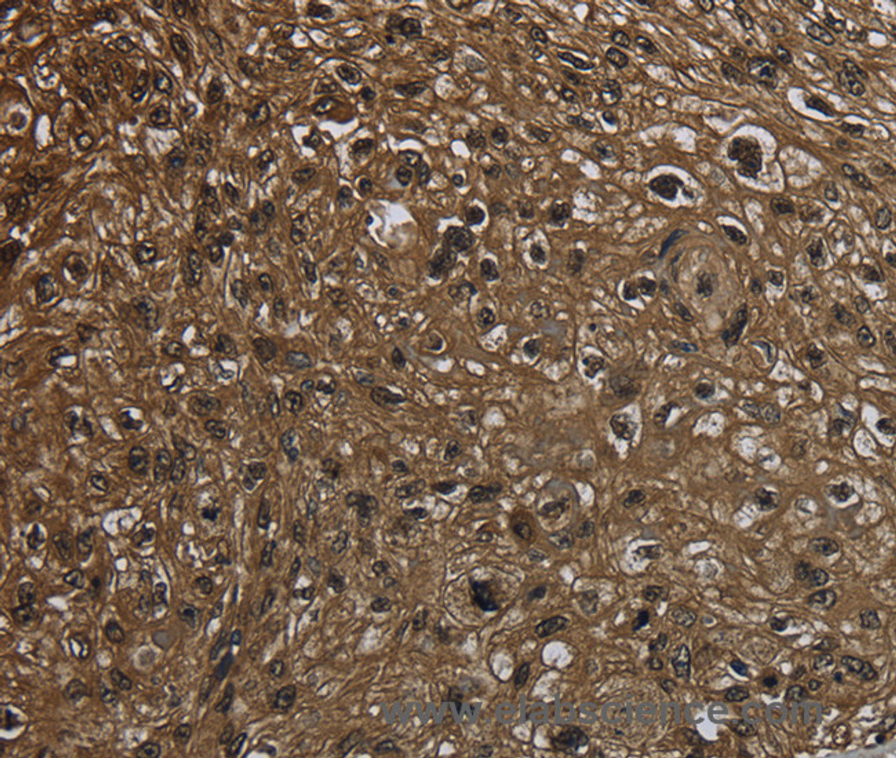 Immunohistochemistry of paraffin-embedded Human esophagus cancer using GLO1 Polyclonal Antibody at dilution of 1:50