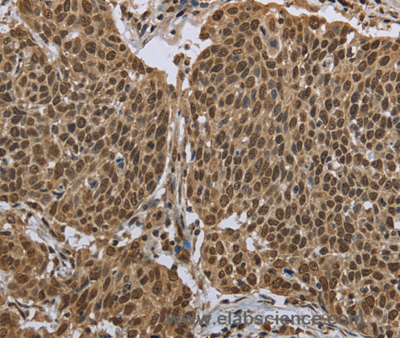 Immunohistochemistry of paraffin-embedded Human cervical cancer using PPAT Polyclonal Antibody at dilution of 1:50
