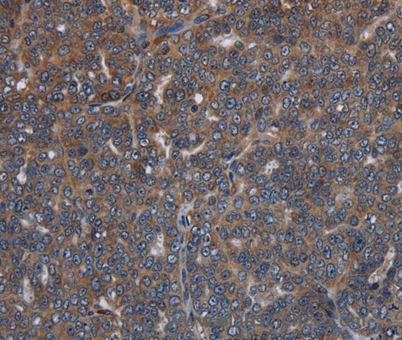 Immunohistochemistry of paraffin-embedded Human ovarian cancer tissue using LETMD1 Polyclonal Antibody at dilution 1:30