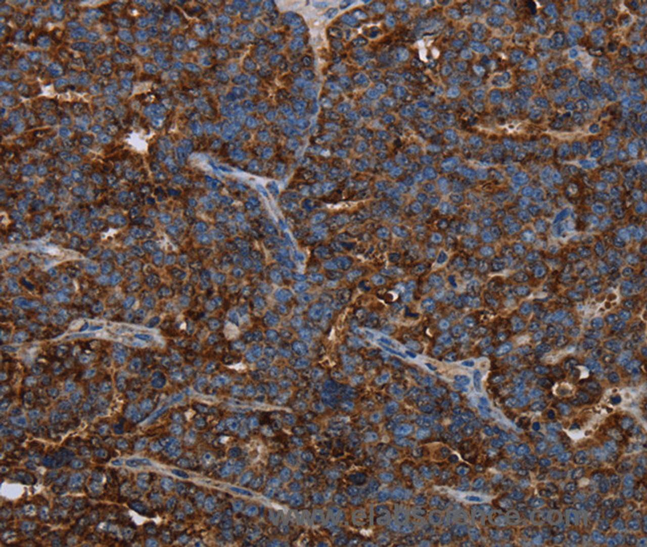 Immunohistochemistry of paraffin-embedded Human ovarian cancer using HMGCL Polyclonal Antibody at dilution of 1:30