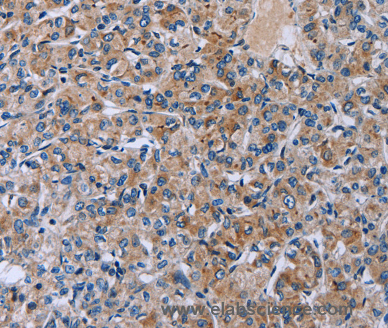 Immunohistochemistry of paraffin-embedded Human prostate cancer tissue using HSD3B2 Polyclonal Antibody at dilution 1:50