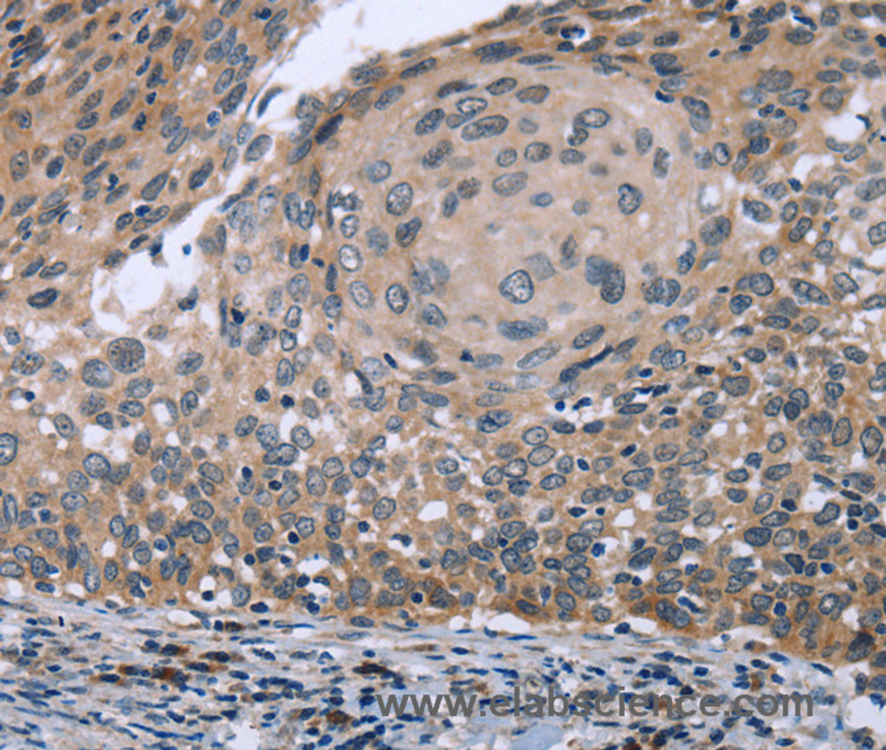 Immunohistochemistry of paraffin-embedded Human cervical cancer using p53RFP Polyclonal Antibody at dilution of 1:50