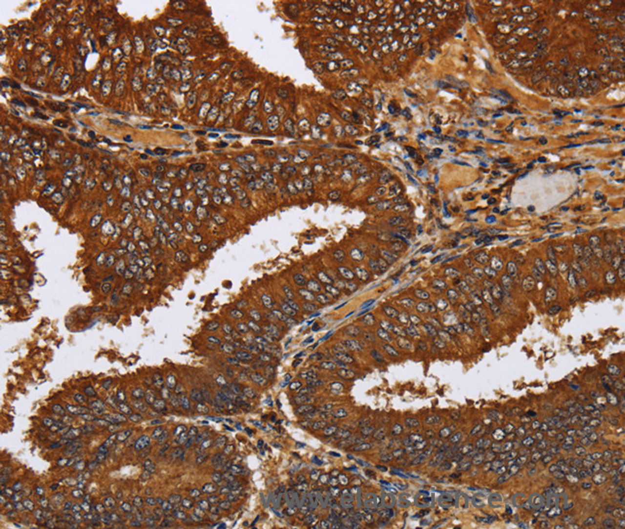 Immunohistochemistry of paraffin-embedded Human colon cancer tissue using TICAM2 Polyclonal Antibody at dilution 1:60