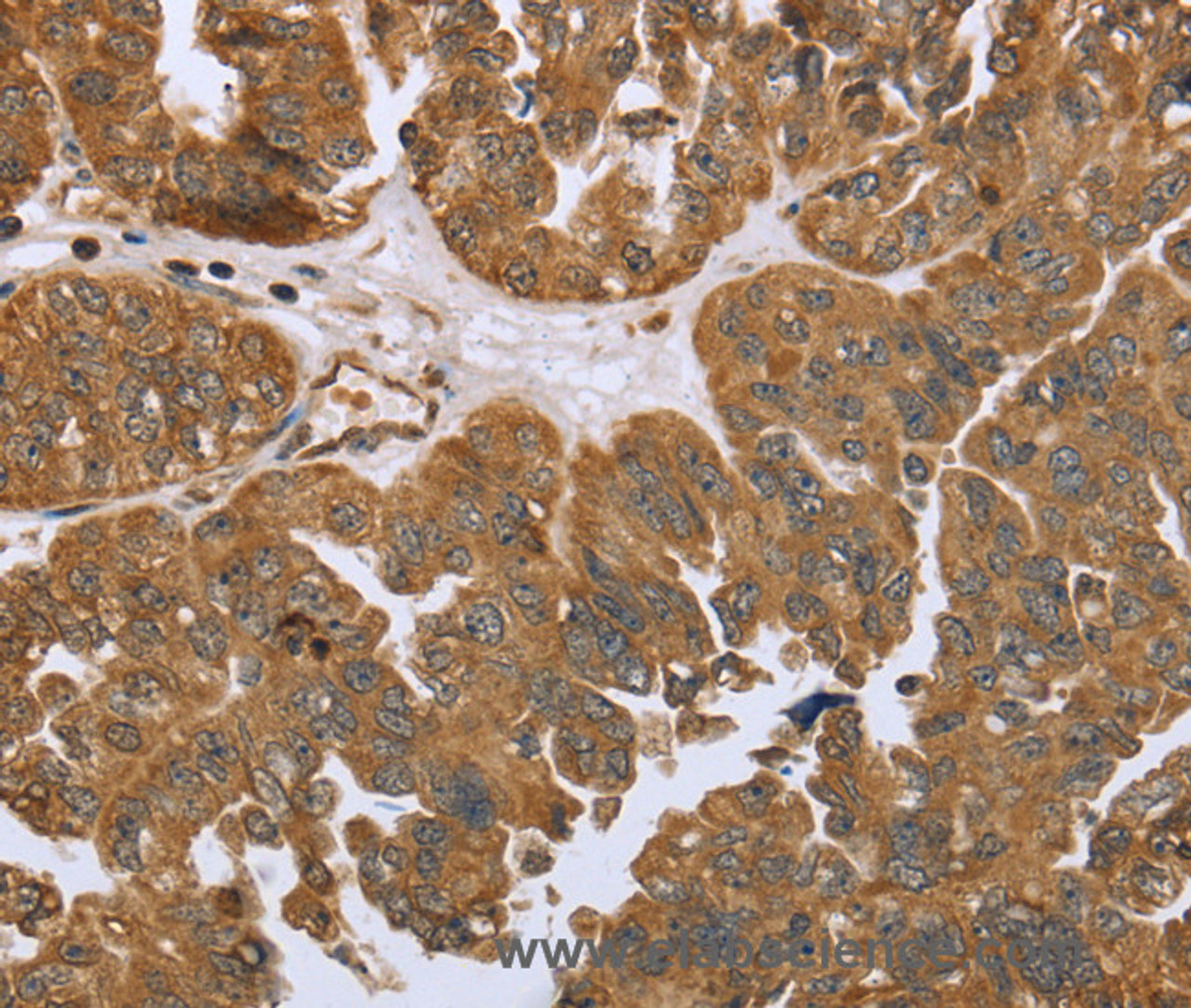 Immunohistochemistry of paraffin-embedded Human ovarian cancer tissue using IKBKE Polyclonal Antibody at dilution 1:30