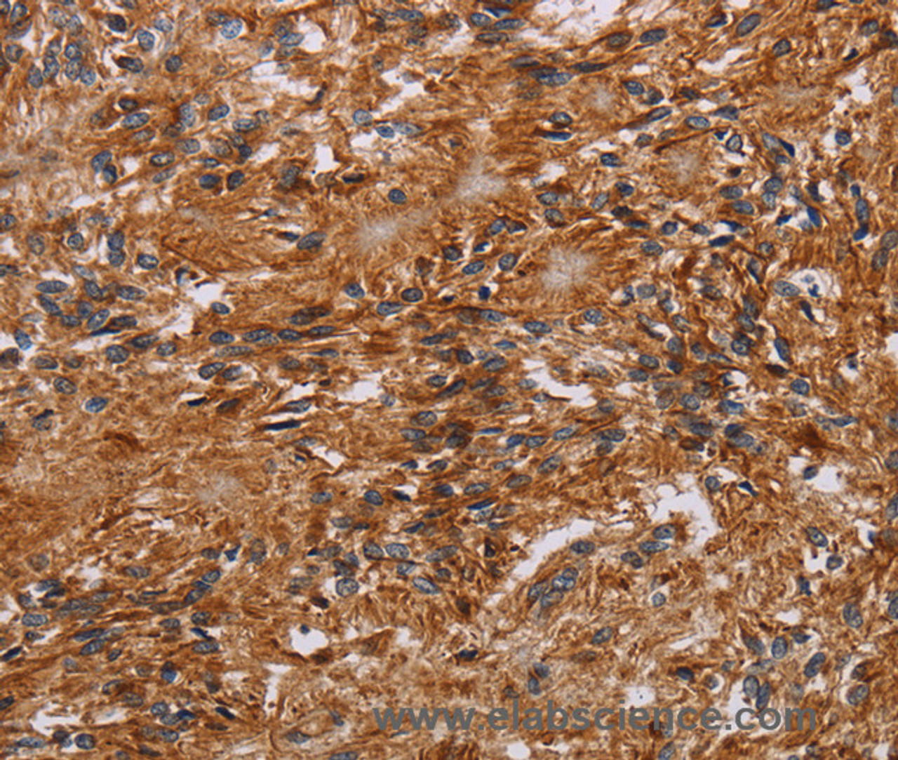 Immunohistochemistry of paraffin-embedded Human ovarian cancer tissue using JAKMIP2 Polyclonal Antibody at dilution 1:40