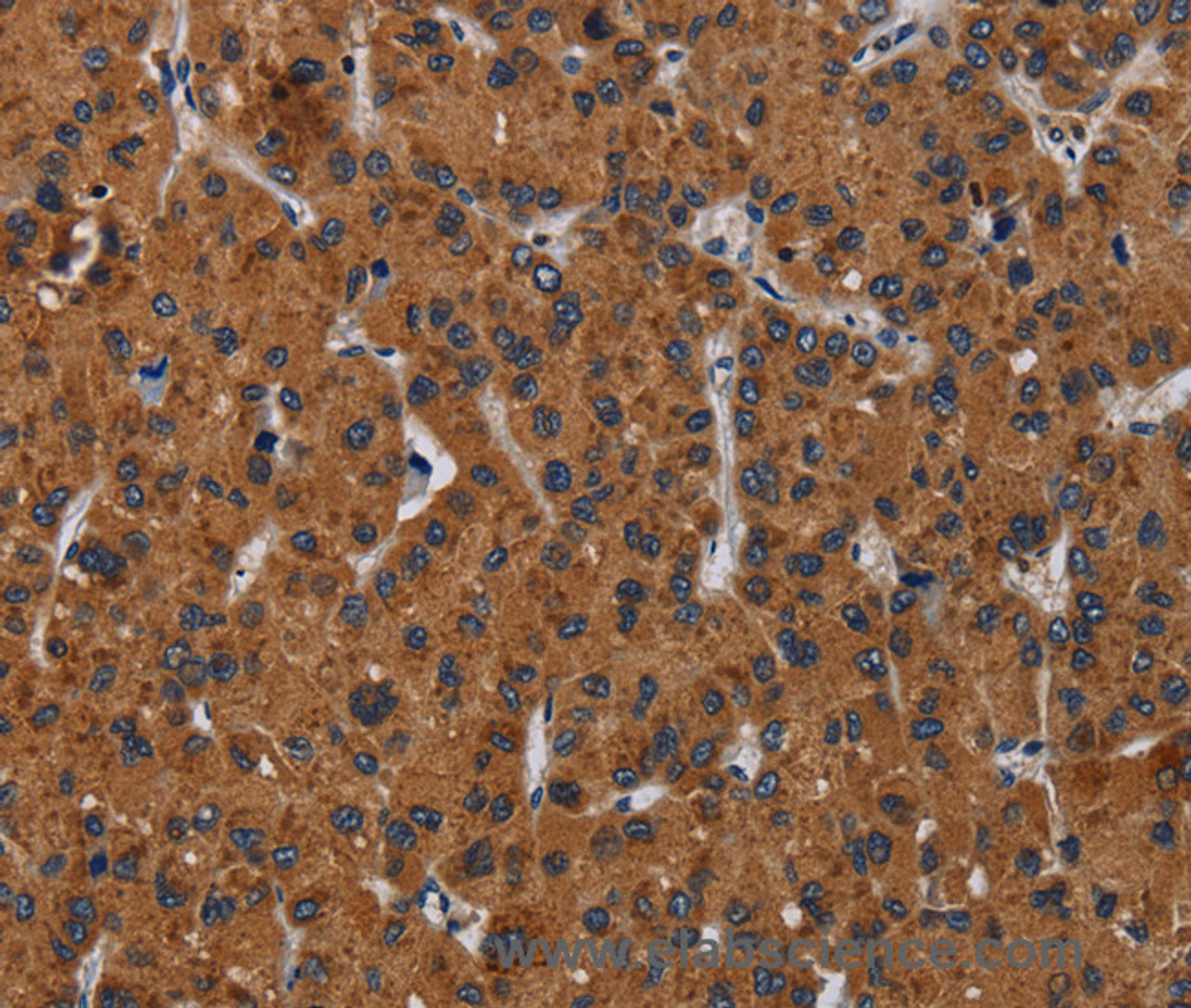 Immunohistochemistry of paraffin-embedded Human liver cancer tissue using KLK8 Polyclonal Antibody at dilution 1:50