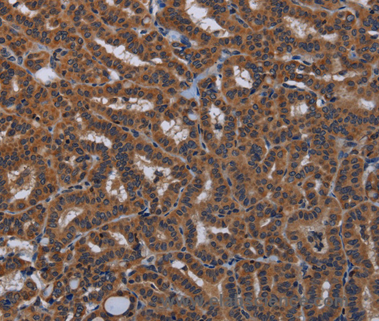 Immunohistochemistry of paraffin-embedded Human thyroid cancer tissue using KLK8 Polyclonal Antibody at dilution 1:50