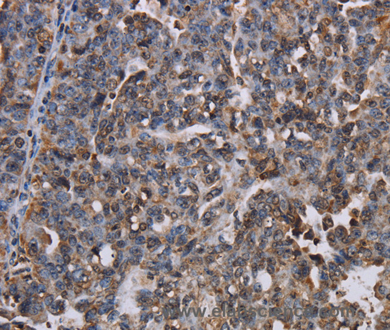 Immunohistochemistry of paraffin-embedded Human ovarian cancer using LBR Polyclonal Antibody at dilution of 1:50