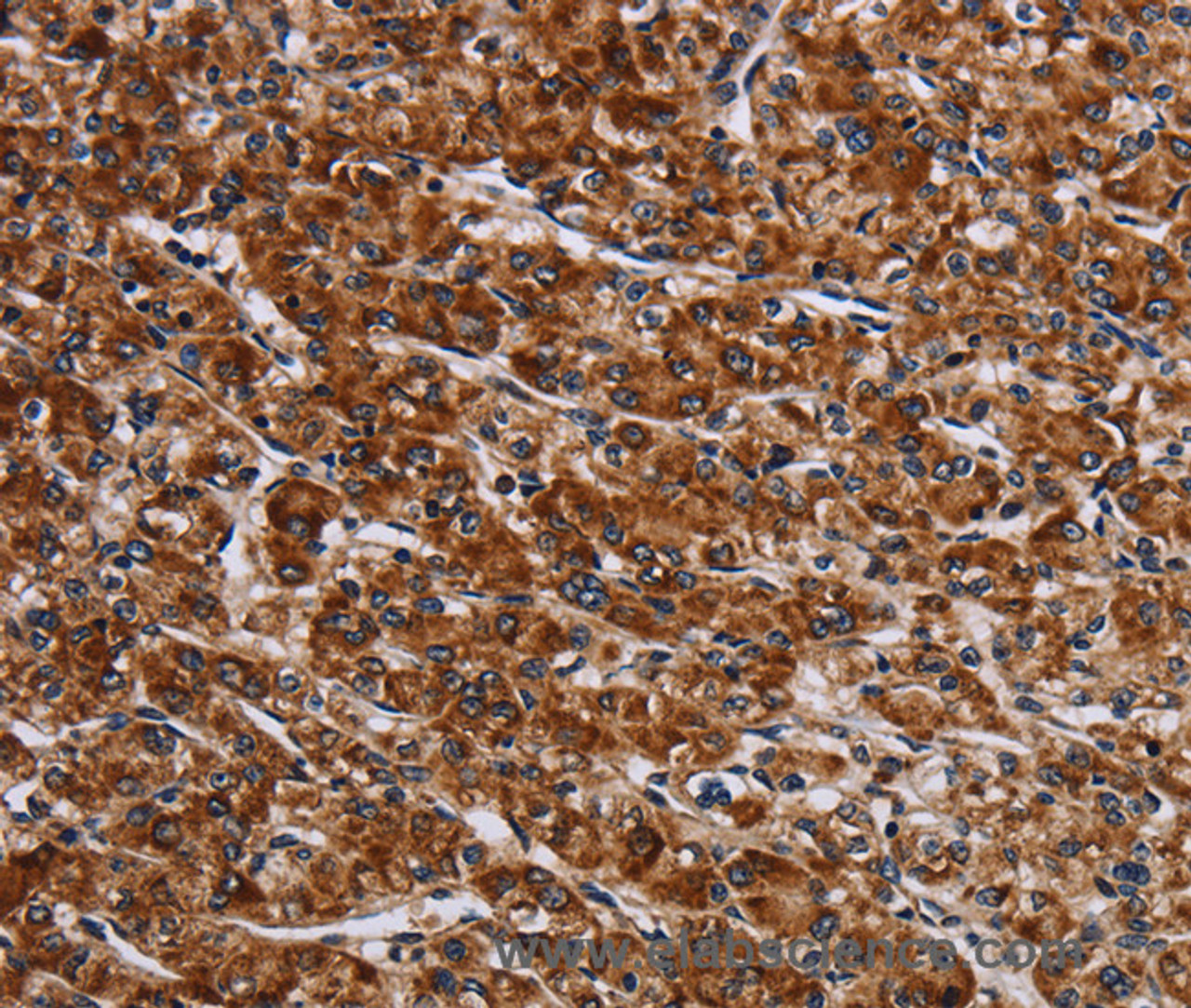 Immunohistochemistry of paraffin-embedded Human prostate cancer tissue using LRRC15 Polyclonal Antibody at dilution 1:60