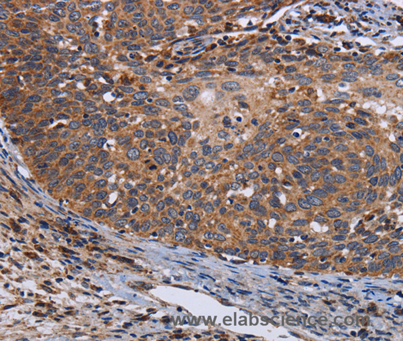 Immunohistochemistry of paraffin-embedded Human cervical cancer tissue using LRRC15 Polyclonal Antibody at dilution 1:60