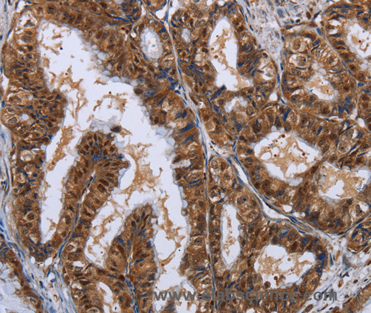 Immunohistochemistry of paraffin-embedded Human esophagus cancer using LTA4H Polyclonal Antibody at dilution of 1:30