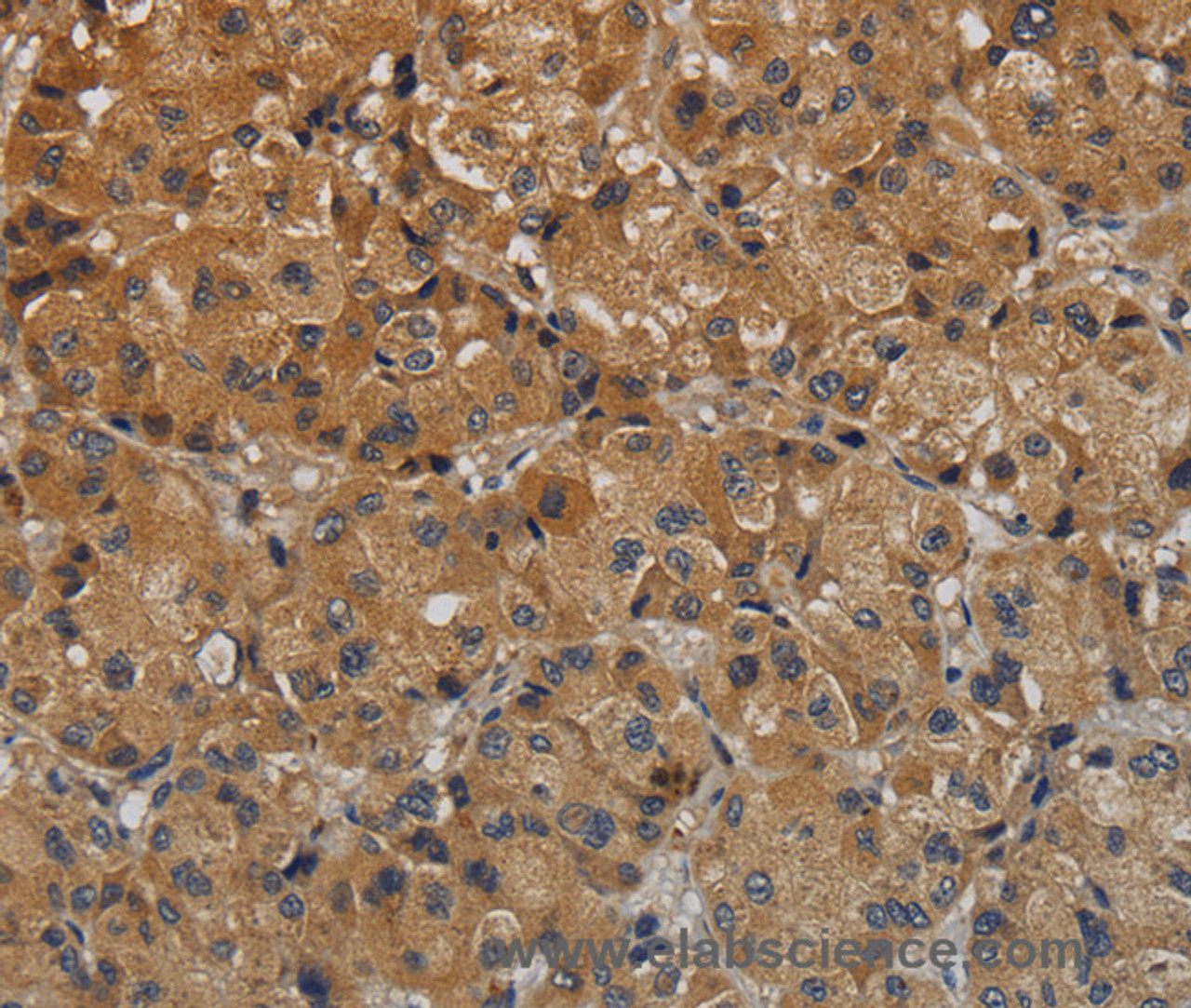 Immunohistochemistry of paraffin-embedded Human liver cancer tissue using TAB1 Polyclonal Antibody at dilution 1:40