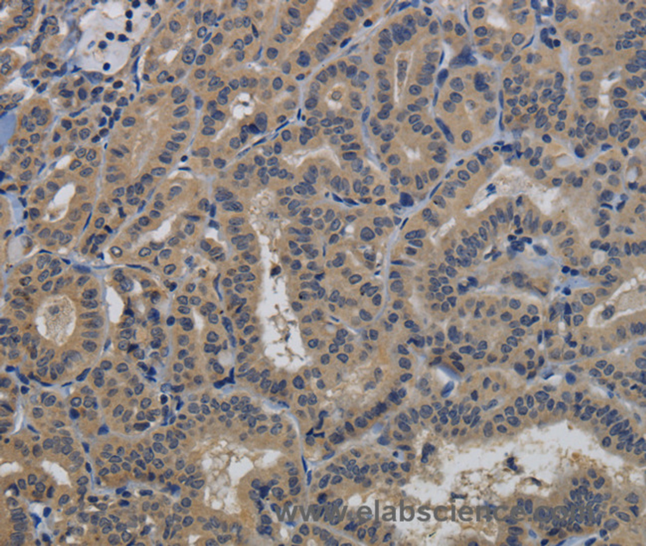Immunohistochemistry of paraffin-embedded Human thyroid cancer tissue using TAB1 Polyclonal Antibody at dilution 1:40