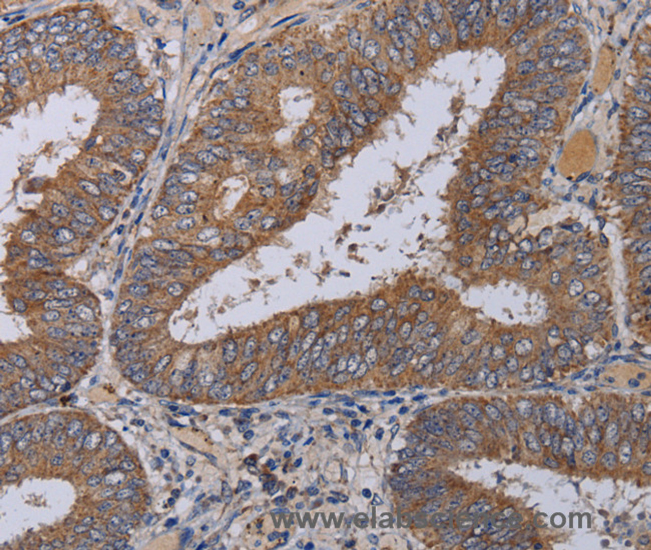 Immunohistochemistry of paraffin-embedded Human colon cancer using ZC3H12A Polyclonal Antibody at dilution of 1:40