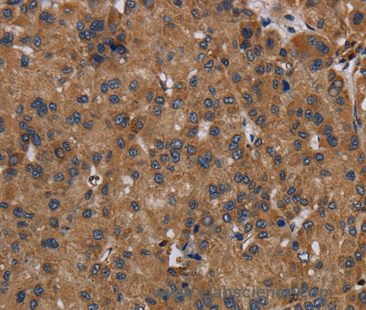 Immunohistochemistry of paraffin-embedded Human liver cancer using NDUFS8 Polyclonal Antibody at dilution of 1:50