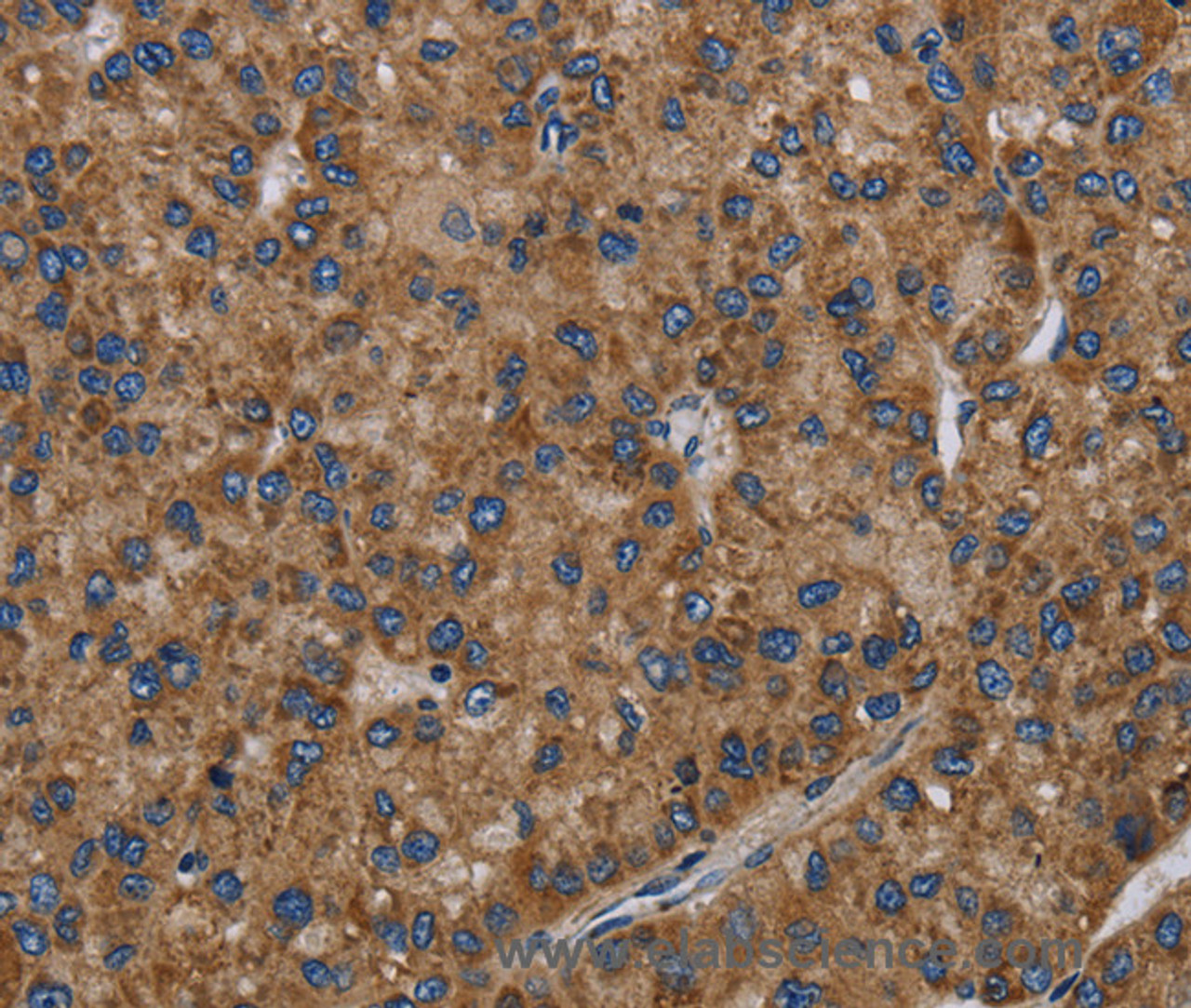 Immunohistochemistry of paraffin-embedded Human liver cancer tissue using NECTIN2 Polyclonal Antibody at dilution 1:40