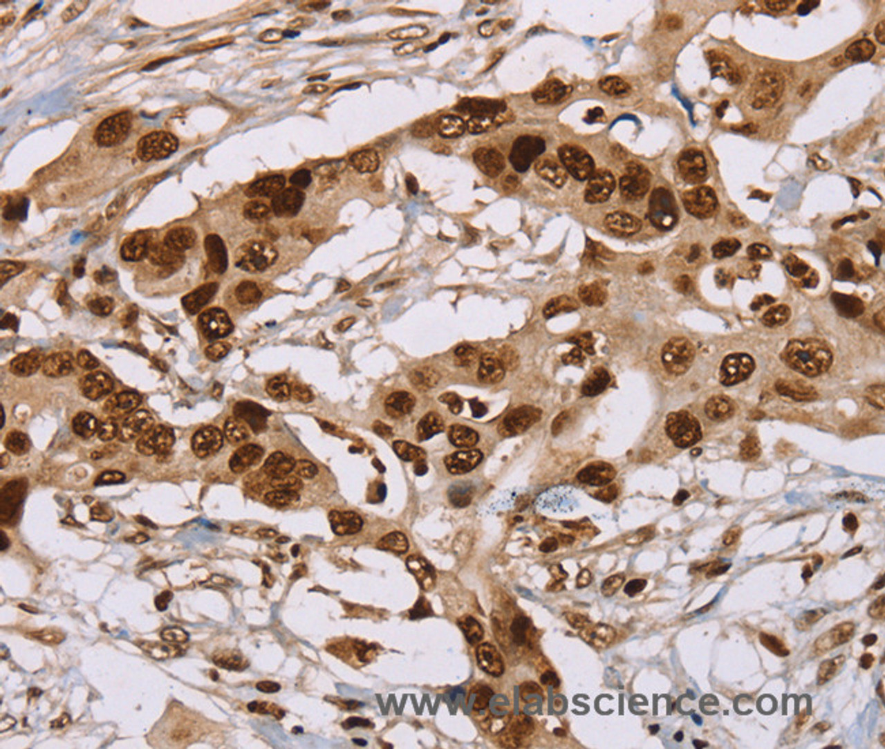 Immunohistochemistry of paraffin-embedded Human colon cancer using NUP50 Polyclonal Antibody at dilution of 1:30