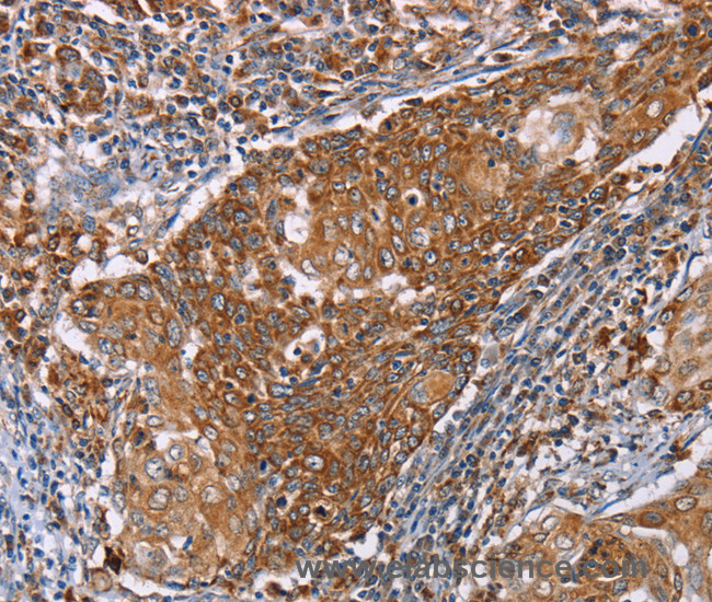 Immunohistochemistry of paraffin-embedded Human cervical cancer tissue using PMPCB Polyclonal Antibody at dilution 1:50