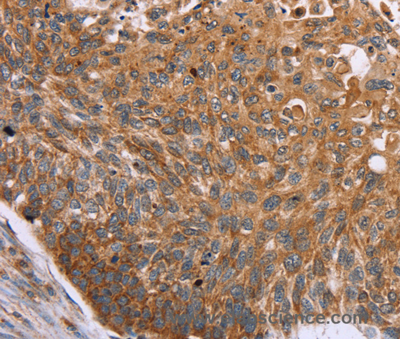 Immunohistochemistry of paraffin-embedded Human esophagus cancer tissue using PMPCB Polyclonal Antibody at dilution 1:50