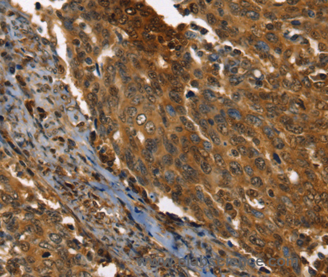 Immunohistochemistry of paraffin-embedded Human cervical cancer using PPIA Polyclonal Antibody at dilution of 1:35