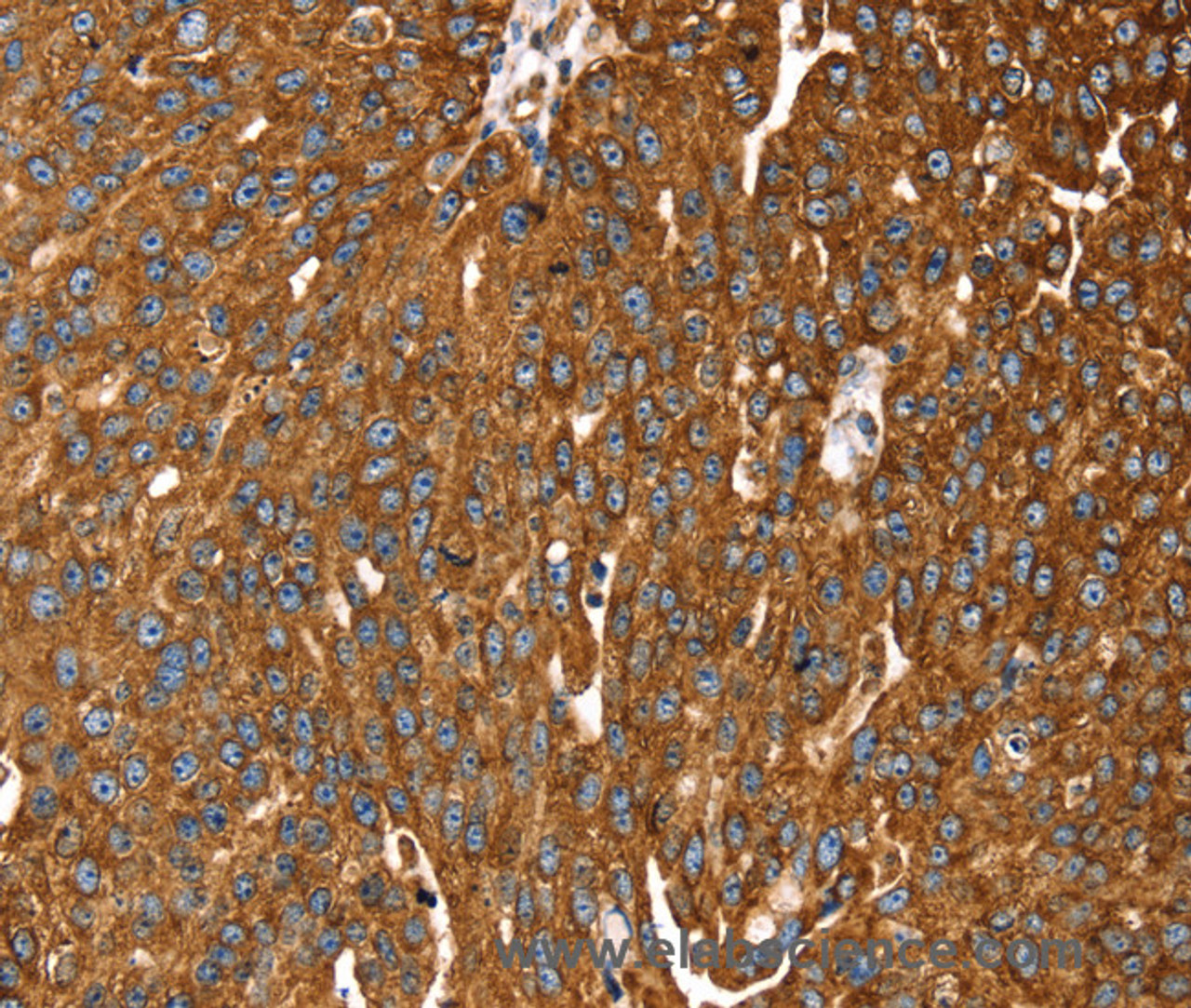 Immunohistochemistry of paraffin-embedded Human breast cancer tissue using RASSF3 Polyclonal Antibody at dilution 1:35