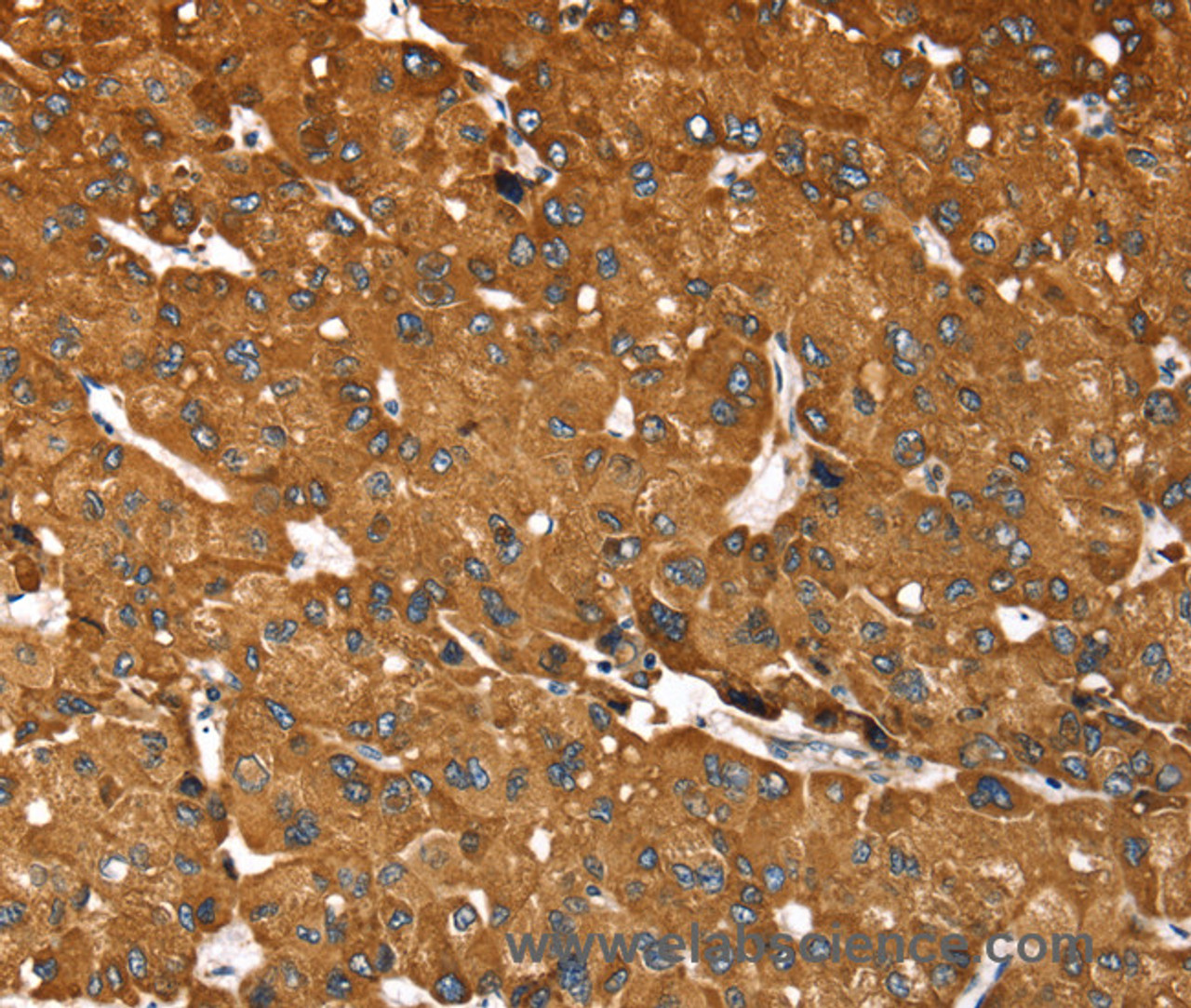 Immunohistochemistry of paraffin-embedded Human liver cancer tissue using RASSF3 Polyclonal Antibody at dilution 1:35