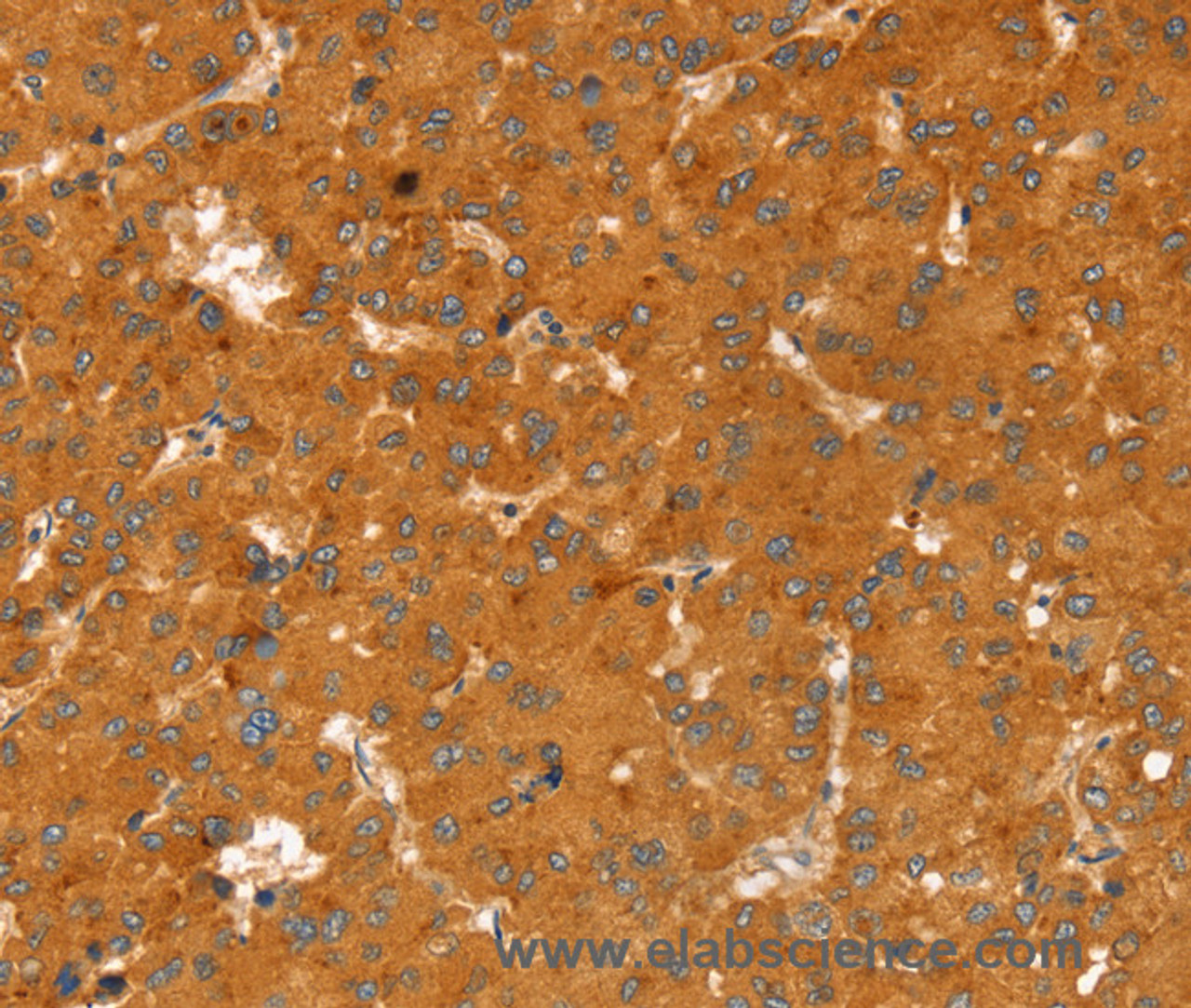 Immunohistochemistry of paraffin-embedded Human liver cancer tissue using RGS4 Polyclonal Antibody at dilution 1:25