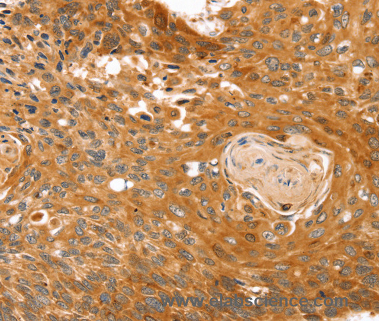 Immunohistochemistry of paraffin-embedded Human esophagus cancer tissue using RGS4 Polyclonal Antibody at dilution 1:25