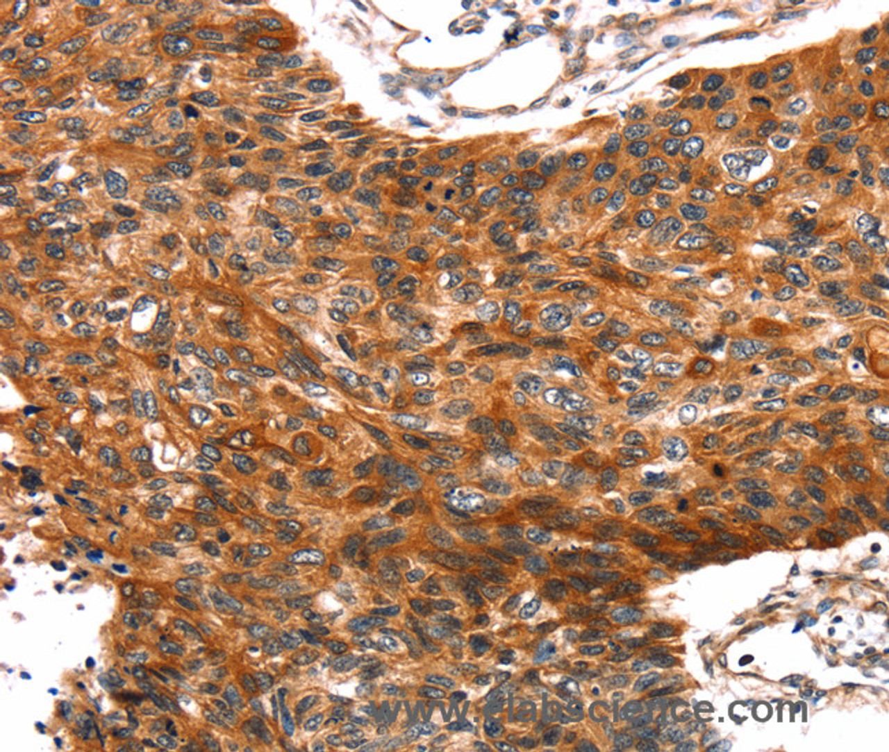 Immunohistochemistry of paraffin-embedded Human esophagus cancer tissue using TRIM69 Polyclonal Antibody at dilution 1:40