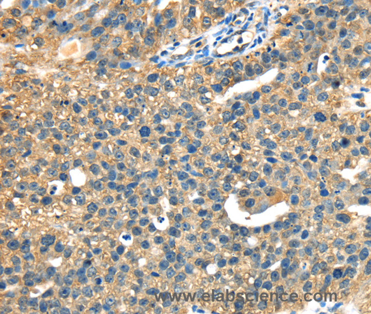 Immunohistochemistry of paraffin-embedded Human breast cancer tissue using DHCR24 Polyclonal Antibody at dilution 1:40